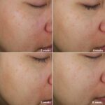 ست ضدلک و روشن کننده و ضدپیری نویج پلاس Comprehensive anti-pigmentation care - Image 2